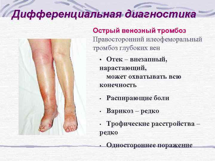 Дифференциальная диагностика Острый венозный тромбоз Правосторонний илеофеморальный тромбоз глубоких вен • Отек – внезапный,