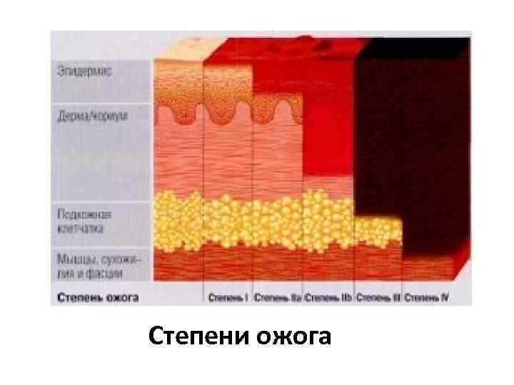 Степени ожога 