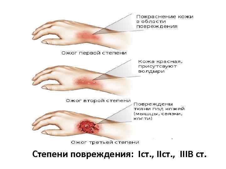 Степени повреждения: Iст. , IIIB ст. 