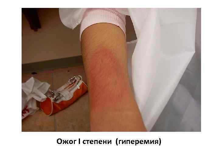 Ожог I степени (гиперемия) 