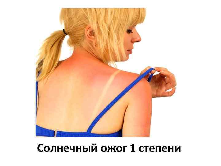 Солнечный ожог 1 степени 