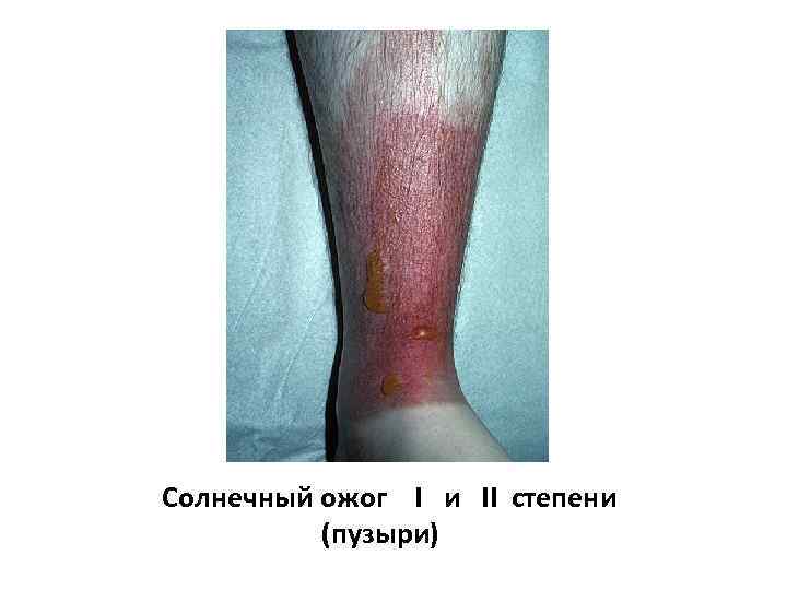 Солнечный ожог I и II степени (пузыри) 