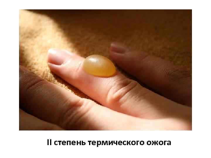 II степень термического ожога 