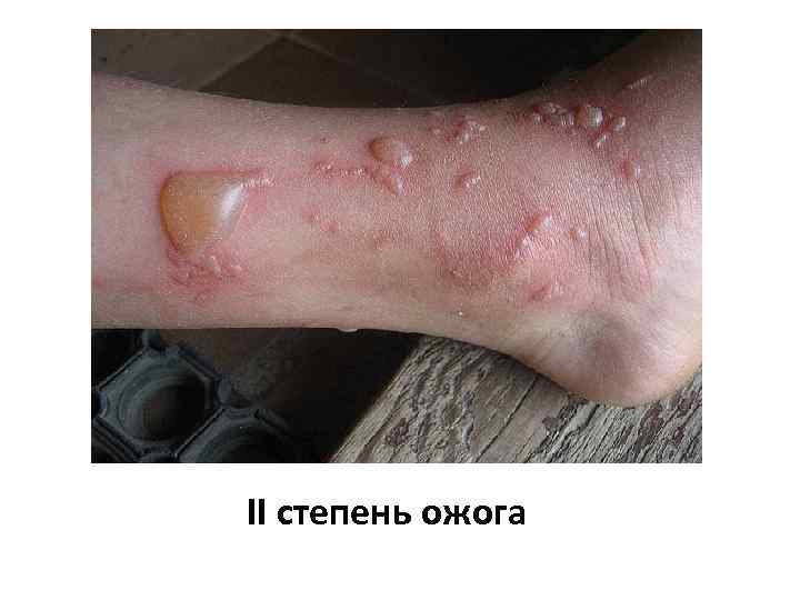 II степень ожога 