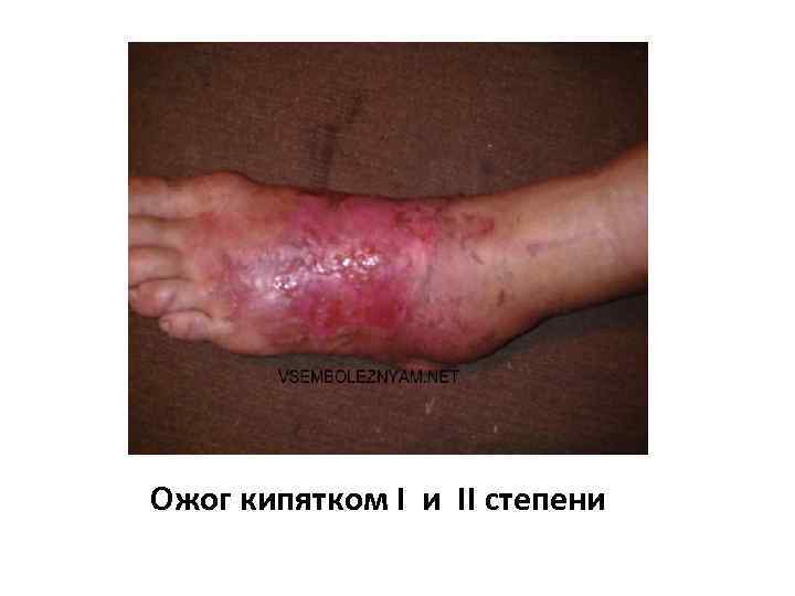 Ожог кипятком I и II степени 