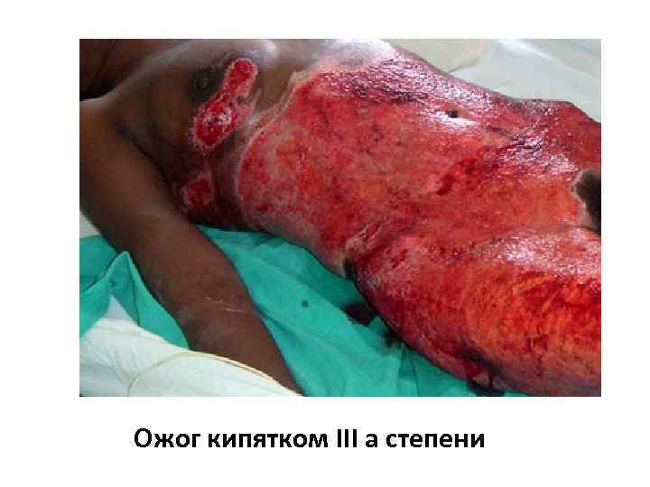 Ожог кипятком III а степени 