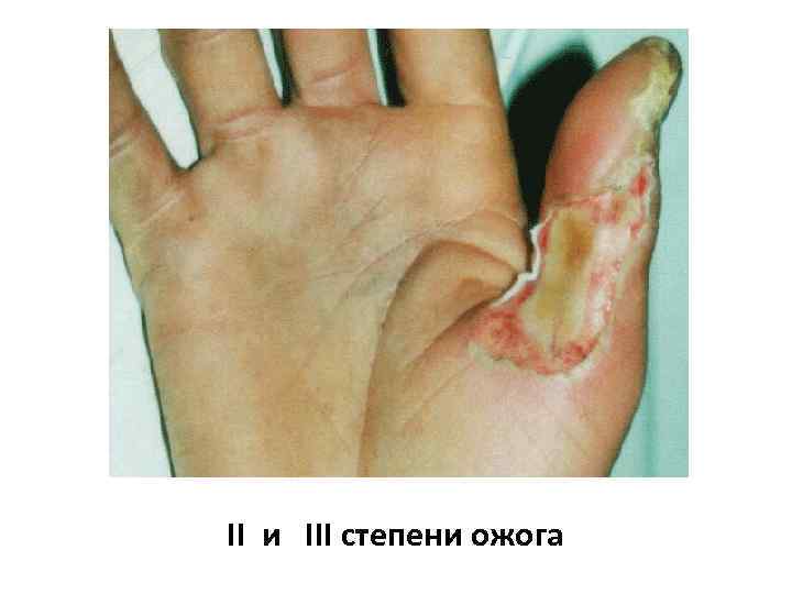 II и III степени ожога 