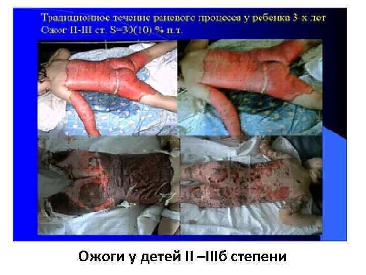 Ожоги у детей II –IIIб степени 
