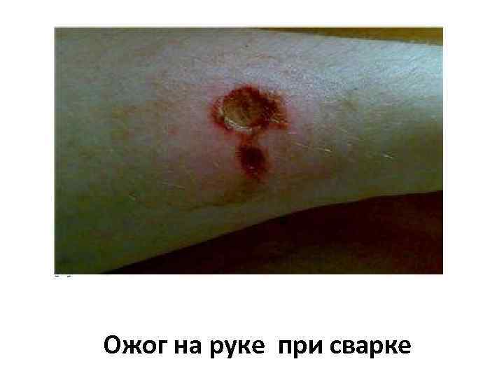 Ожог на руке при сварке 