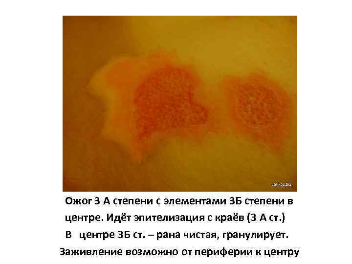 Ожог 3 А степени с элементами 3 Б степени в центре. Идёт эпителизация с
