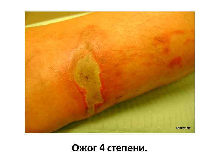 Ожог 4 степени. 