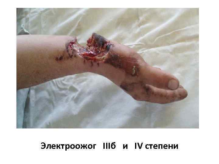 Электроожог IIIб и IV степени 