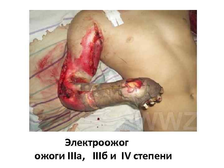 Электроожоги IIIа, IIIб и IV степени 