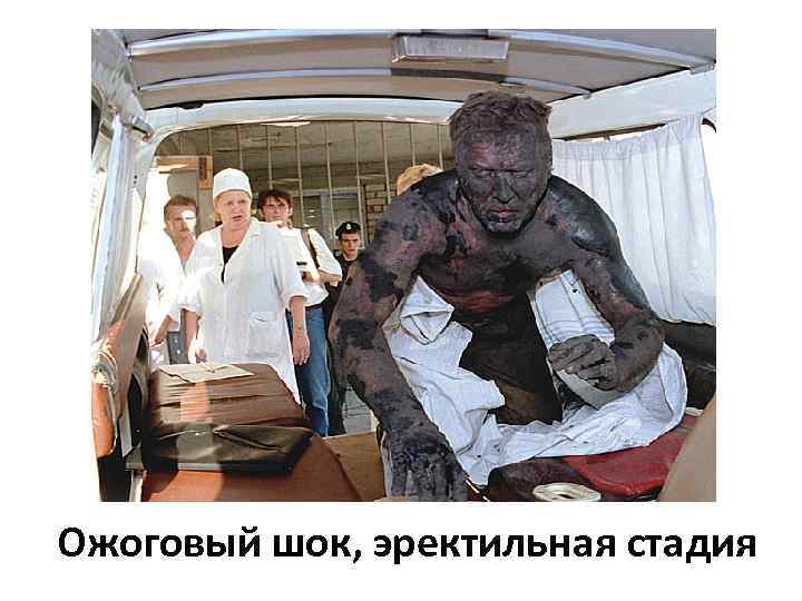 Ожоговый шок, эректильная стадия 