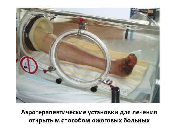 Аэротерапевтические установки для лечения открытым способом ожоговых больных 