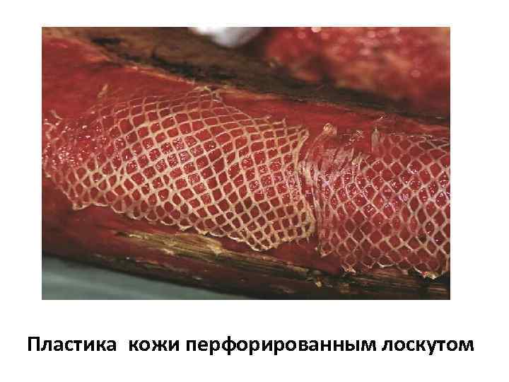 Пластика кожи перфорированным лоскутом 