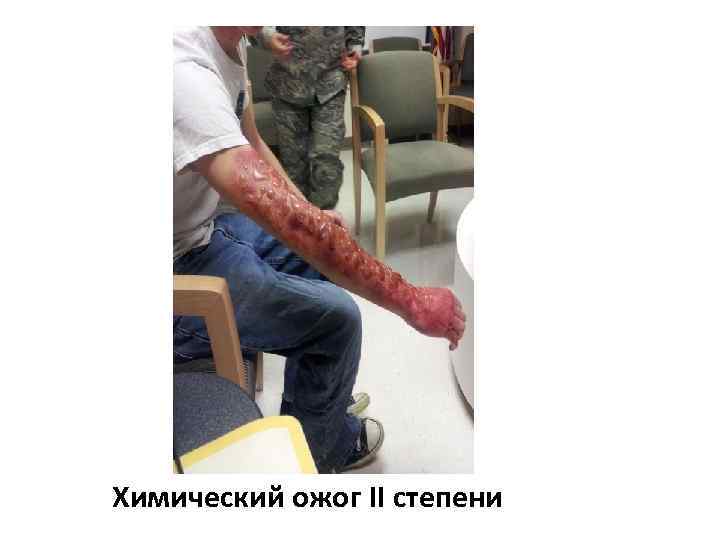 Химический ожог II степени 