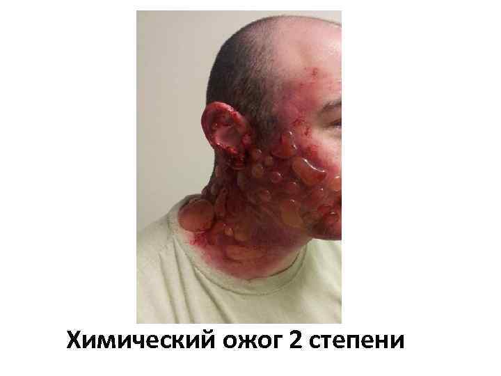 Химический ожог 2 степени 