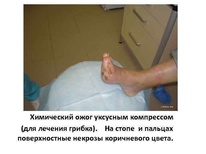 Химический ожог уксусным компрессом (для лечения грибка). На стопе и пальцах поверхностные некрозы коричневого