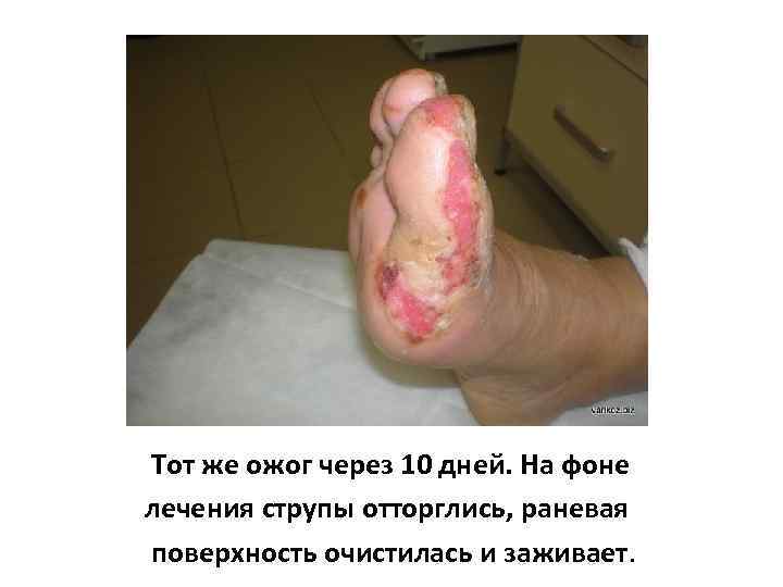 Тот же ожог через 10 дней. На фоне лечения струпы отторглись, раневая поверхность очистилась