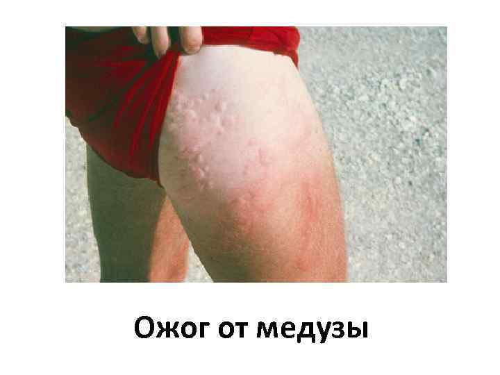 Ожог от медузы 