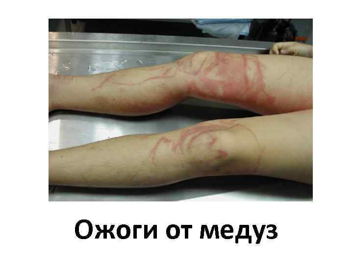 Ожоги от медуз 