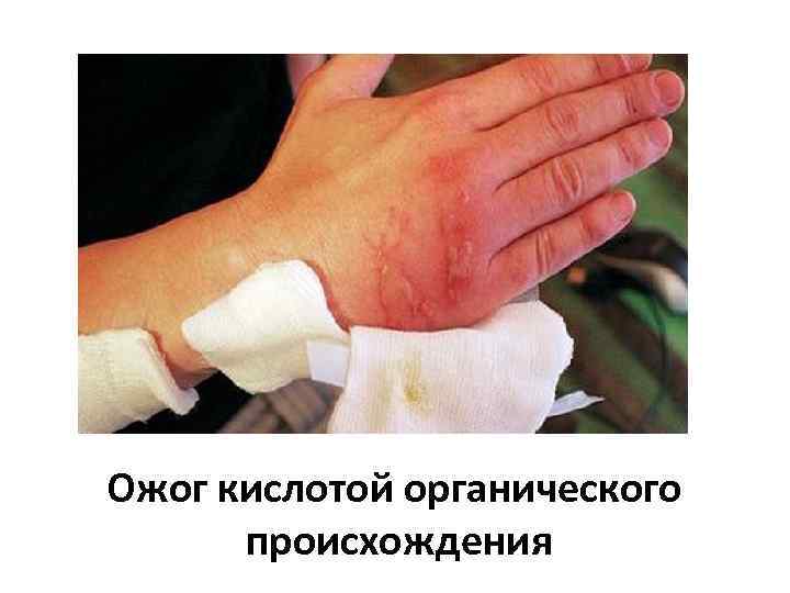 Ожог кислотой органического происхождения 