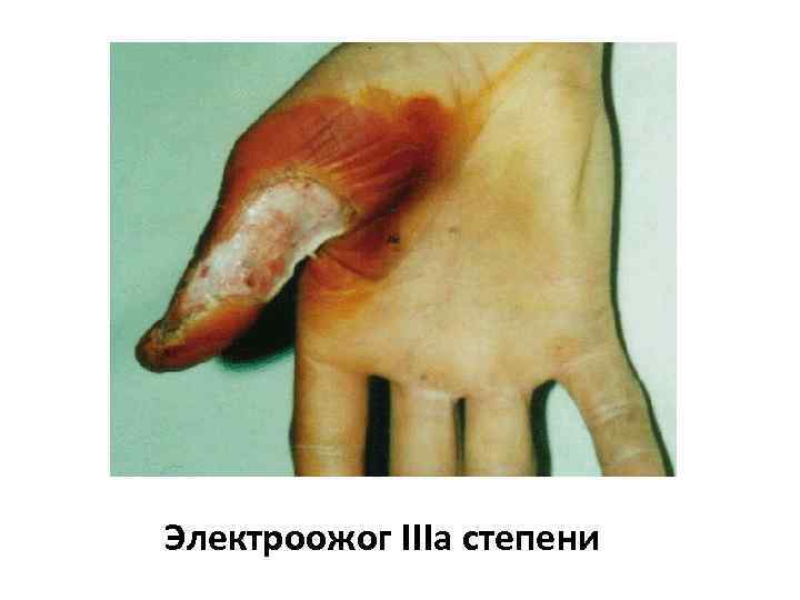 Электроожог IIIа степени 