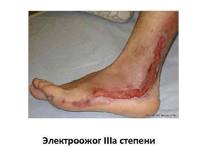 Электроожог IIIа степени 