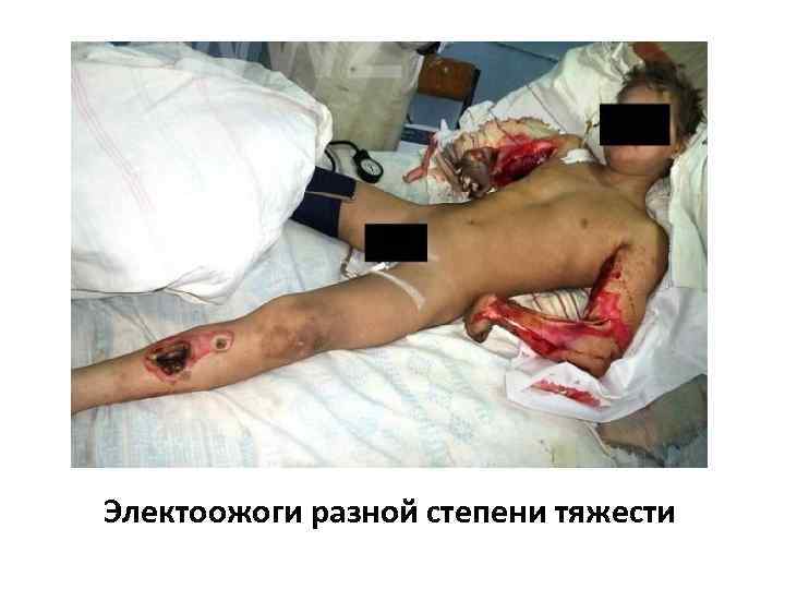 Электоожоги разной степени тяжести 