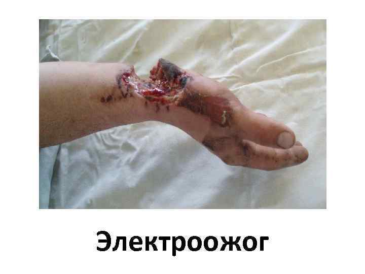 Электроожог 