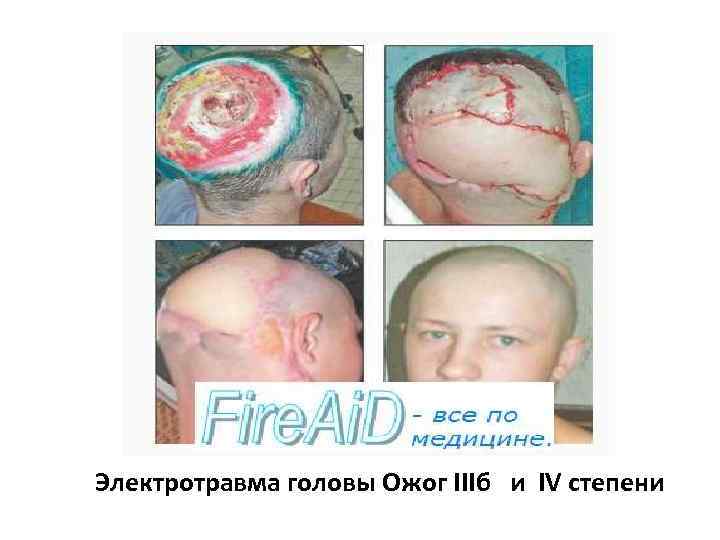 Электротравма головы Ожог IIIб и IV степени 