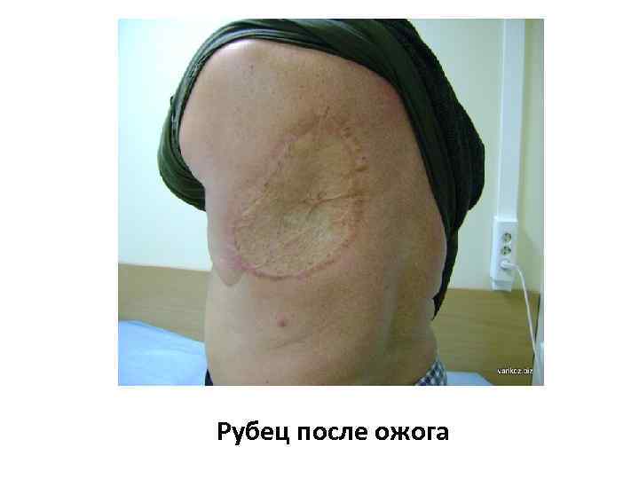 Рубец после ожога 