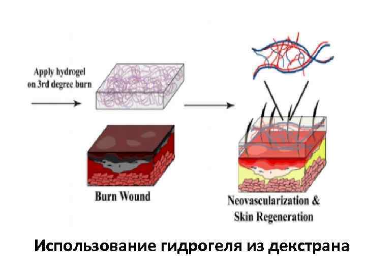 Использование гидрогеля из декстрана 