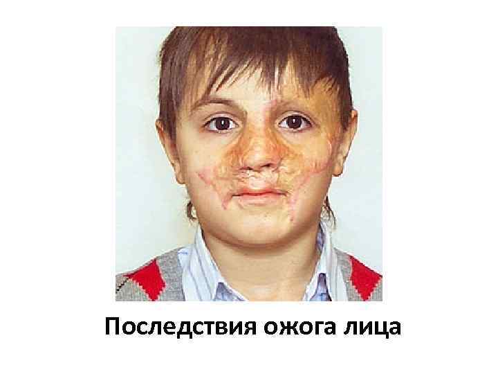 Последствия ожога лица 