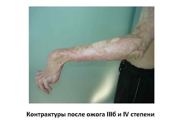 Контрактуры после ожога IIIб и IV степени 
