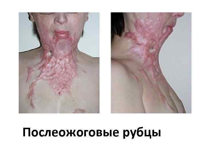 Послеожоговые рубцы 