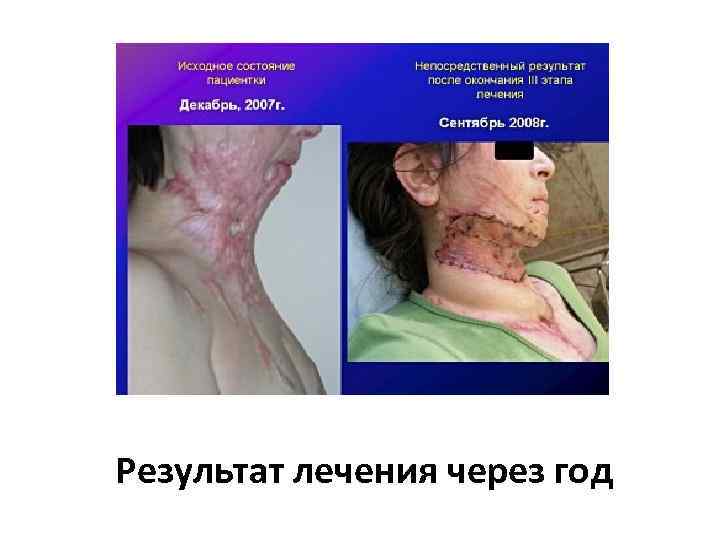 Результат лечения через год 