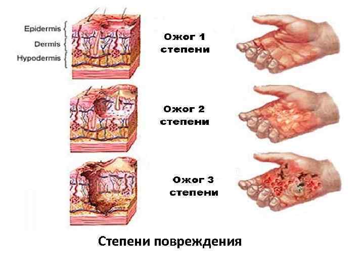 Степени повреждения 
