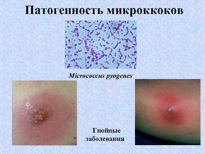 Патогенность микроккоков Micrococcus pyogenes Гнойные заболевания 