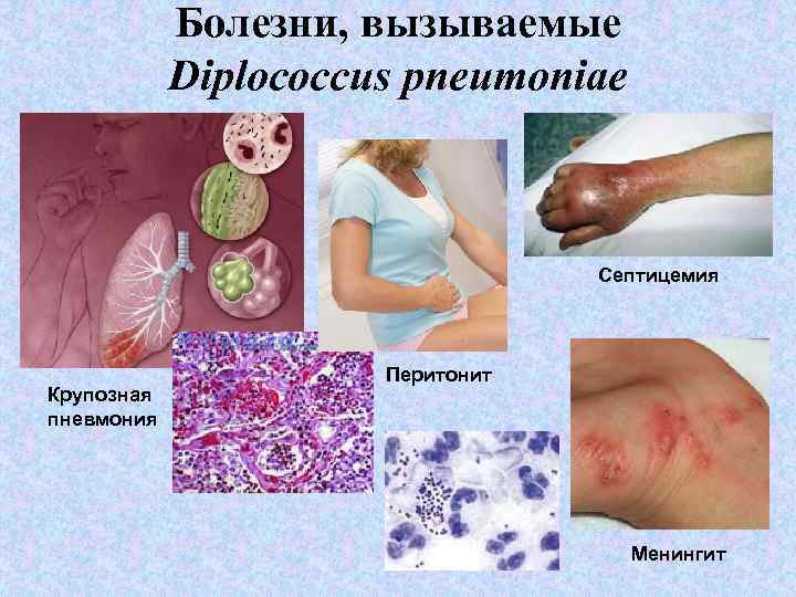 Болезни, вызываемые Diplococcus pneumoniae Септицемия Крупозная пневмония Перитонит Менингит 