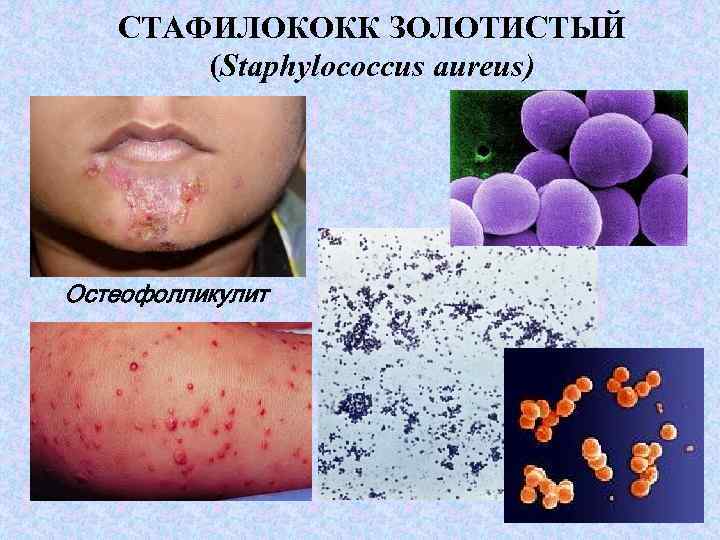 СТАФИЛОКОКК ЗОЛОТИСТЫЙ (Staphylococcus aureus) Остеофолликулит 