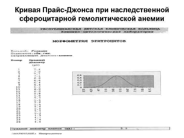 Кривая Прайс-Джонса при наследственной сфероцитарной гемолитической анемии 