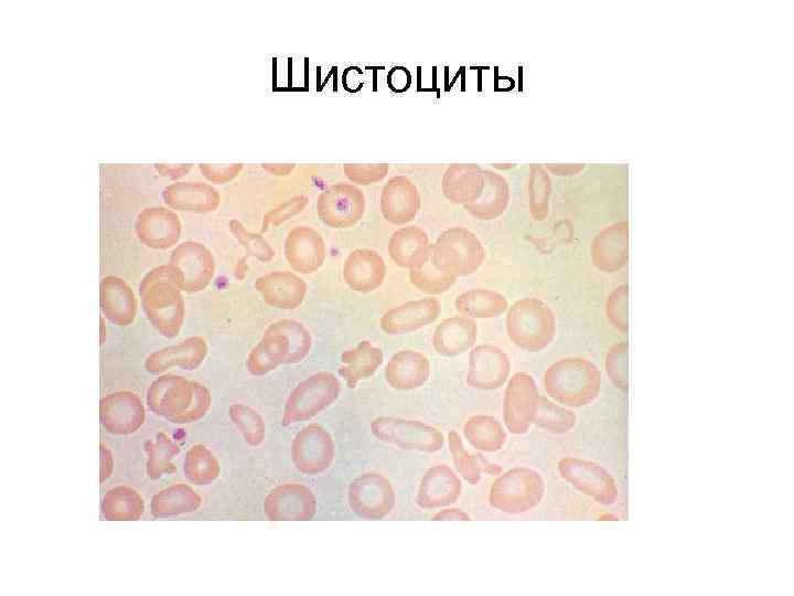 Шистоциты 
