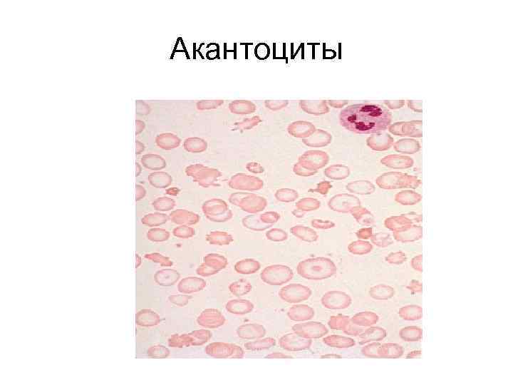 Акантоциты 