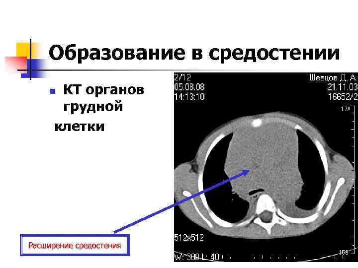 Образование в средостении КТ органов грудной клетки n Расширение средостения 