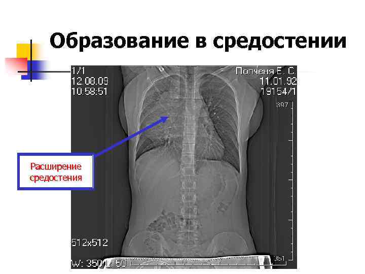 Образование в средостении Расширение средостения 