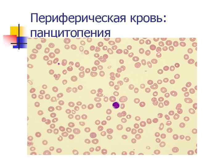 Периферическая кровь: панцитопения 