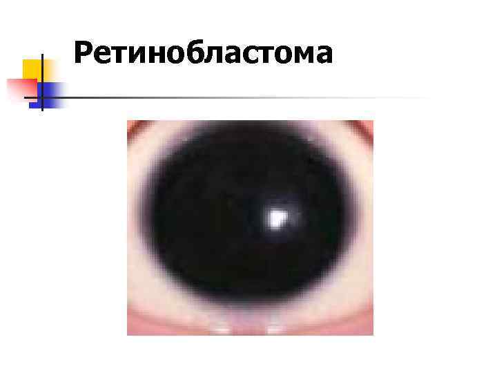 Ретинобластома 