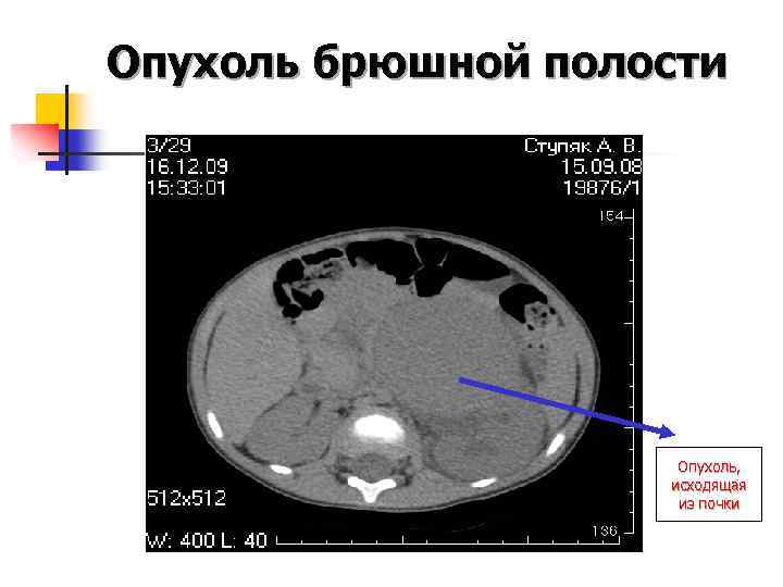 Объемное образование. Опухоль брюшной полости. Новообразование брюшной полости. Объемное образование брюшной полости. Внеорганные объемные образования брюшной полости.